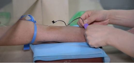 刺血后刺血地方胀痛是什么原因,刺血疗法出不来血是什么原因