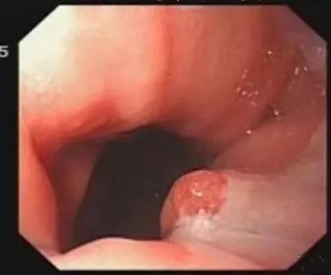 一文盘点｜临床上常见的息肉病