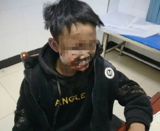 孩子燃放烟花爆竹发生安全事故,13岁男孩燃放鞭炮爆炸
