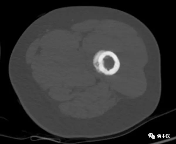 「安心过年」微创手术直击病灶！两骨瘤患者慕名而来，携健康回家