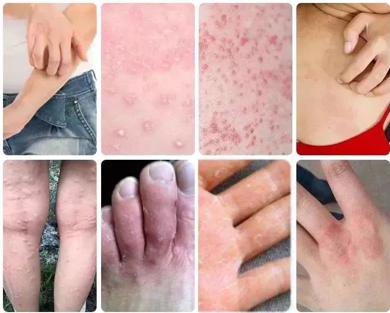 脚气湿疹止痒最快的软膏,湿疹止痒膏可以治脚气吗