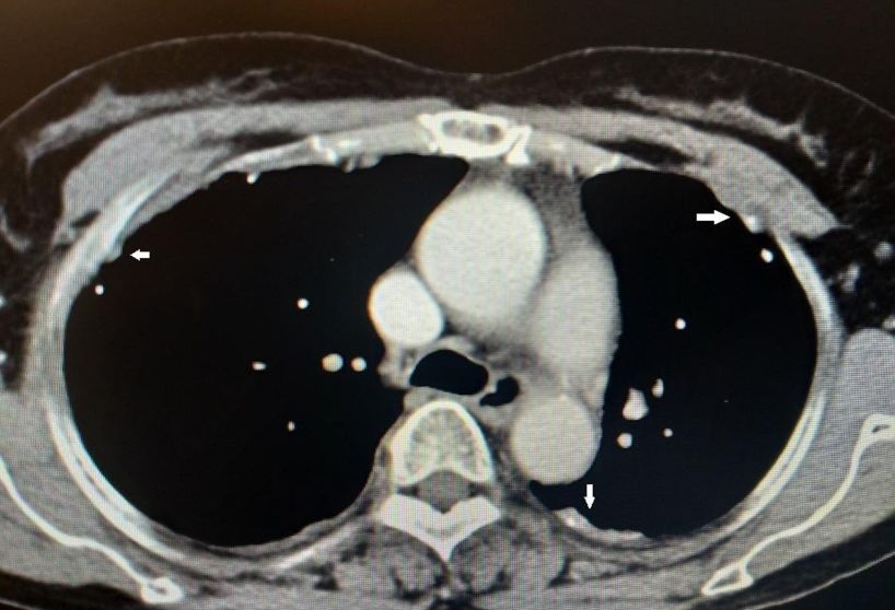 50岁女性胸腔积液是怎么形成的呢,26岁胸腔积液引起原因