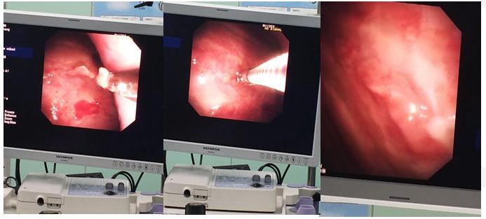 50岁女性胸腔积液是怎么形成的呢,26岁胸腔积液引起原因