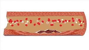 血管堵演示,血管堵塞100张图片