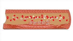 血管堵演示,血管堵塞100张图片
