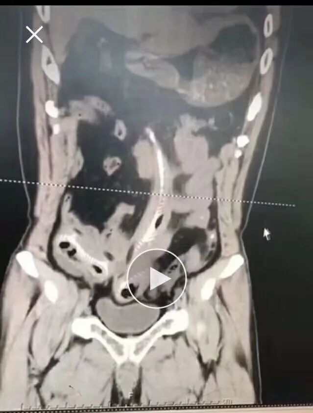 男子肛门塞进三条泥鳅，知道原因医生要哭了…