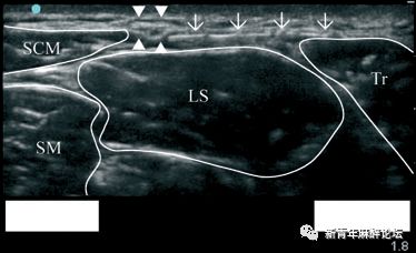 落枕了怎么办最快最有效方法,落枕了怎么办按什么穴位
