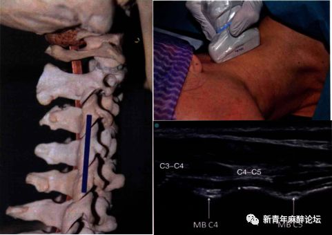 落枕了怎么办最快最有效方法,落枕了怎么办按什么穴位
