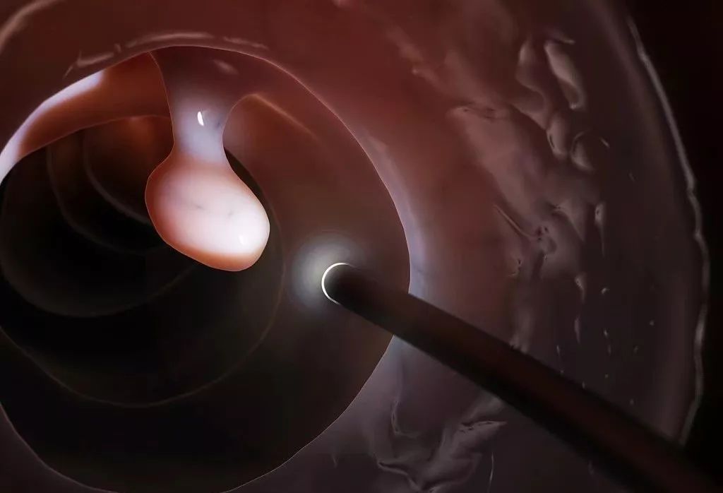 息肉为什么切完还会长,息肉为什么割不净