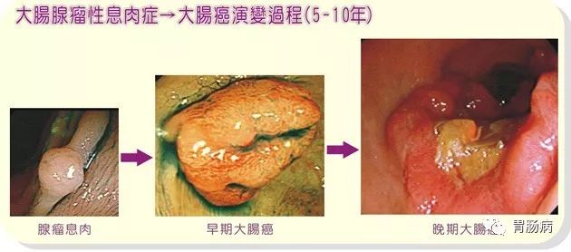 息肉为什么切完还会长,息肉为什么割不净