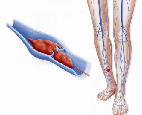 久坐久站谨慎下肢静脉曲张,久坐人群预防静脉血栓小技巧