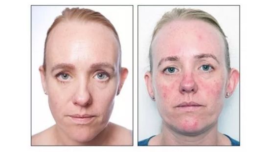 卸妆油致痘视频,卸妆油爆痘怎么修复