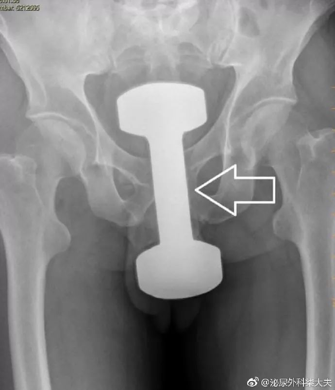 男子肛门塞进三条泥鳅，知道原因医生要哭了…