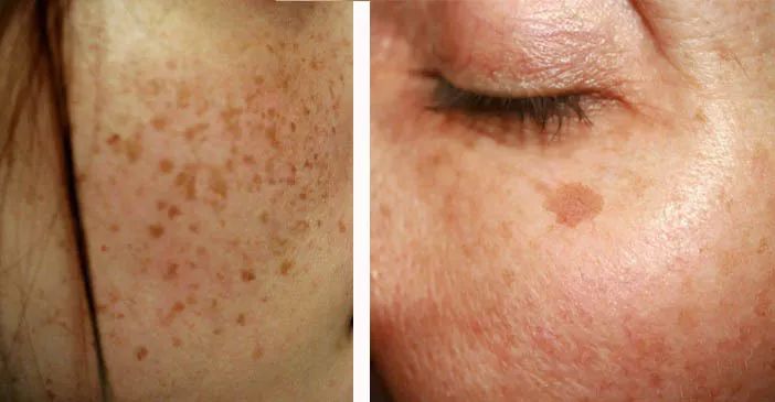 5个祛斑小妙招淡化晒斑雀斑痘印,痘印晒斑和疤痕用什么产品比较好