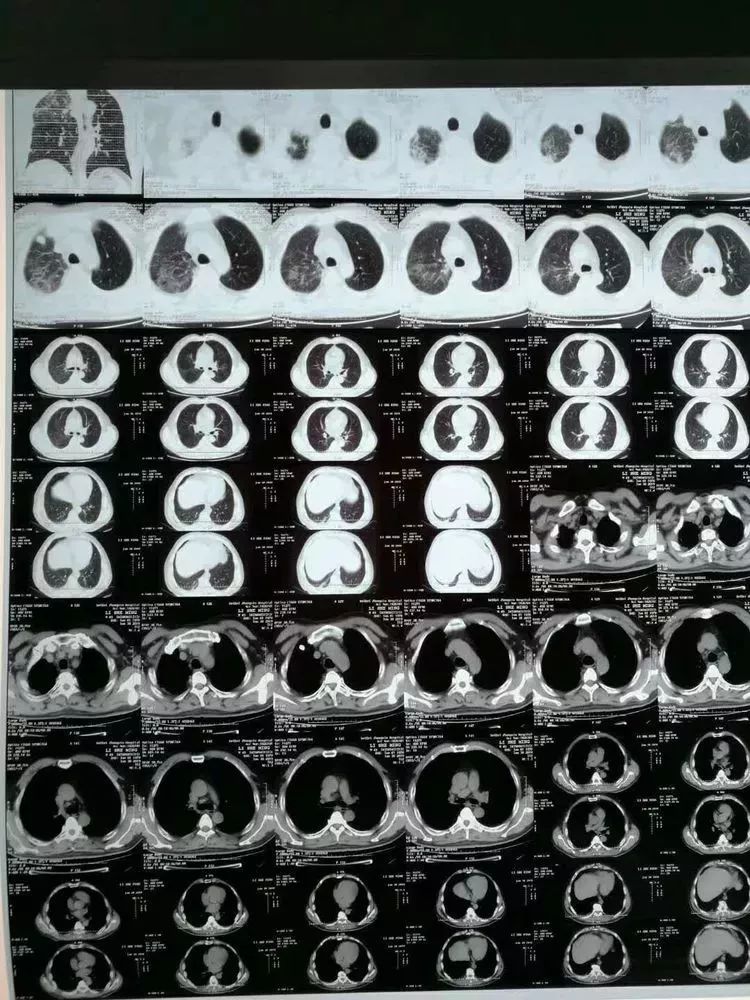 渭北中心医院呼吸内科成功救治一例重症肺炎患者