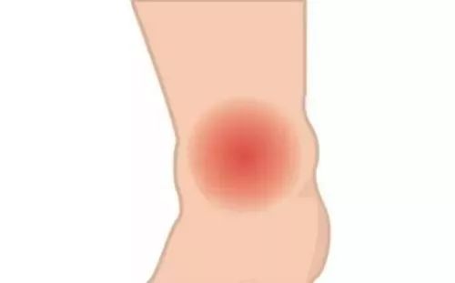 糖友尿里有潜血,尿蛋白3+是糖尿病肾病吗