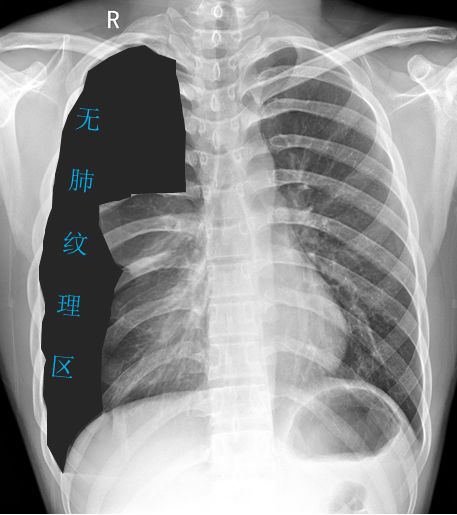 气胸的x线表现胸膜炎,胸外科气胸病人病例