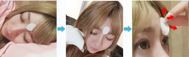 眉间纹抬头纹祛皱效果好吗,祛皱淡纹美容院