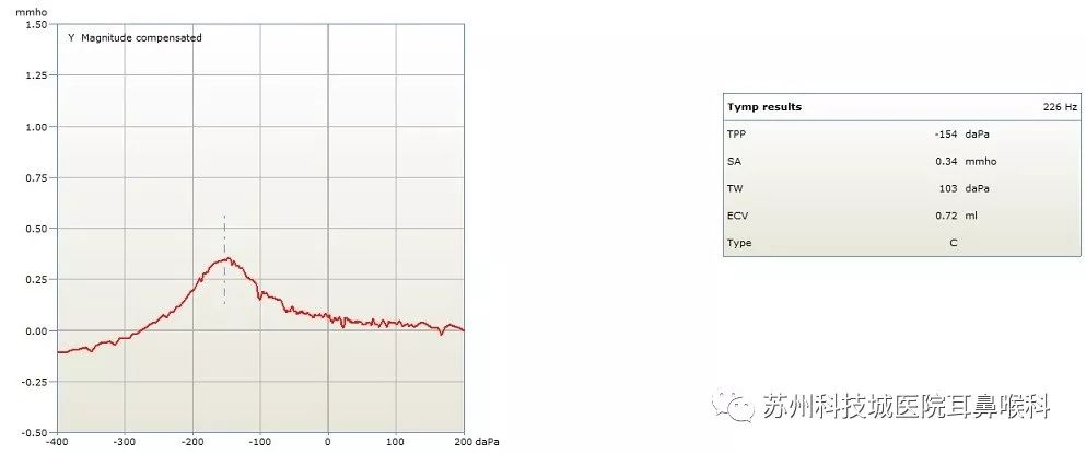 声导抗检测报告怎么看,声导抗测试报告中mep多少正常
