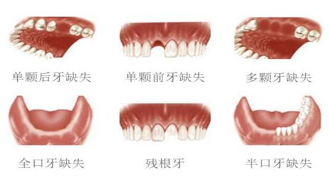急急急！全城寻找缺牙、难看牙市民，每人最高获助20000元！