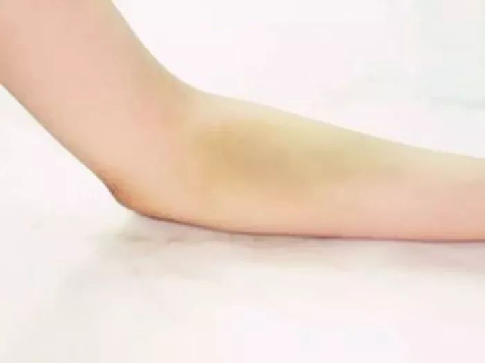 献血后有淤青怎么回事,献血后手臂上大面积出现淤青