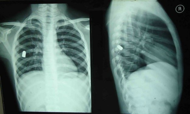 人体中弹会怎么样,人体中枪后果