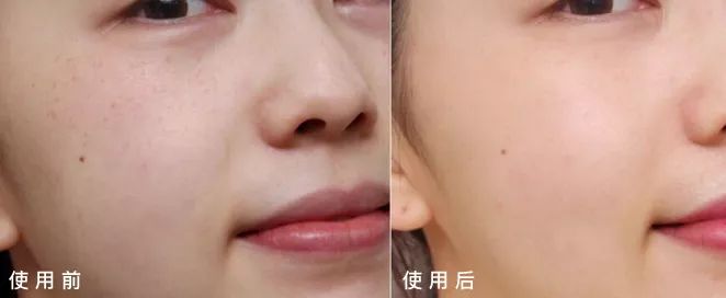 5个祛斑小妙招淡化晒斑雀斑痘印,痘印晒斑和疤痕用什么产品比较好