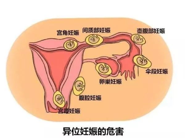 你对糖尿病知多少,异位妊娠知识点