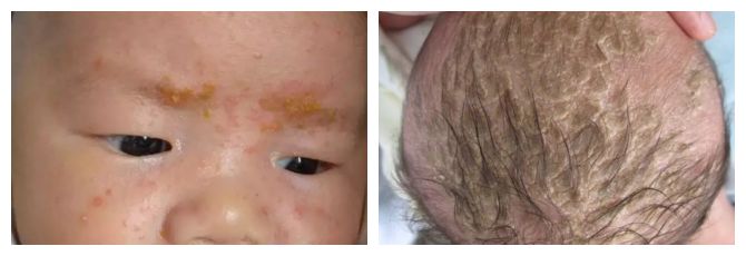 夏季宝宝湿疹高发新手妈妈看过来,婴儿特殊类型的湿疹以及皮炎