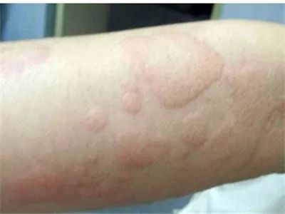 夏季宝宝湿疹高发新手妈妈看过来,婴儿特殊类型的湿疹以及皮炎