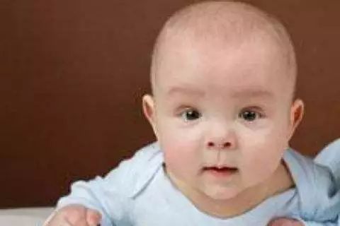 夏季宝宝湿疹高发新手妈妈看过来,婴儿特殊类型的湿疹以及皮炎