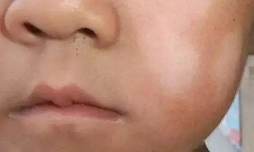 夏季宝宝湿疹高发新手妈妈看过来,婴儿特殊类型的湿疹以及皮炎