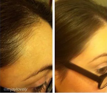 拯救发际线增加发量洗发水,生发发际线的神器测评