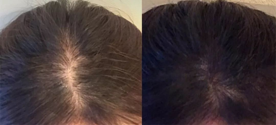 拯救发际线增加发量洗发水,生发发际线的神器测评