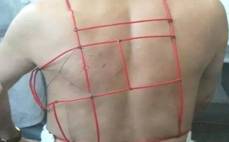 蛇盘疮带状疱疹可以吃病毒灵吗 (蛇缠头带状疱疹)