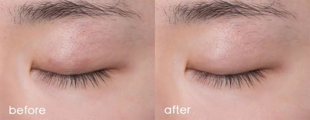 埋线双眼皮分叉修护动作,双眼皮埋线术后关注事项大全