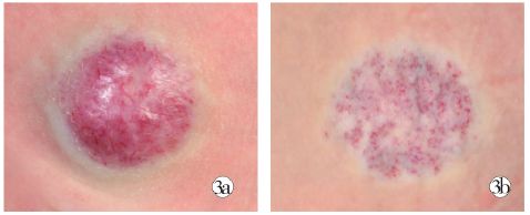 宝宝身上有这六种胎记,宝宝身上这8种胎记需要密切关注