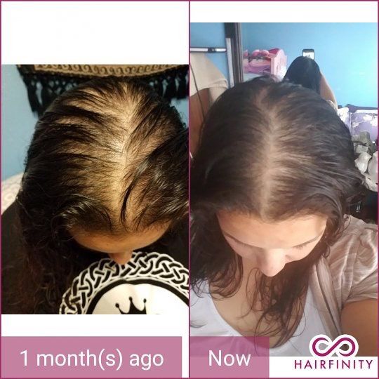 拯救发际线增加发量洗发水,生发发际线的神器测评