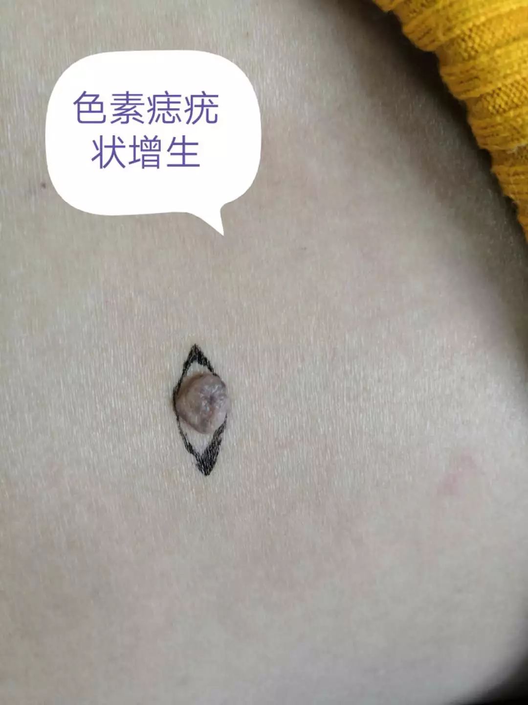 小小黑痣该不该治？该如何治？