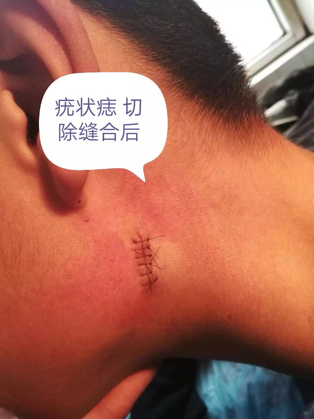 小小黑痣该不该治？该如何治？