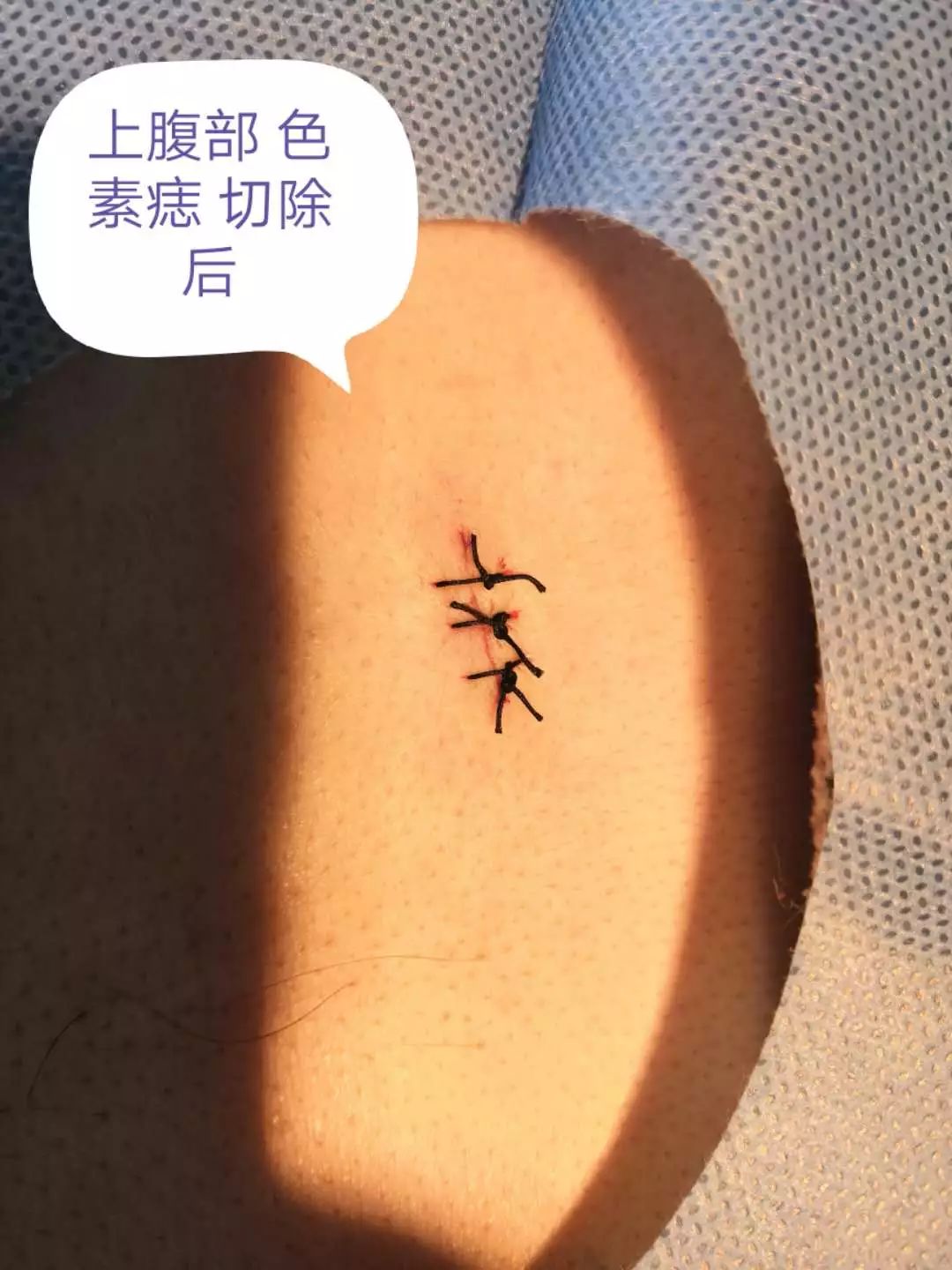 小小黑痣该不该治？该如何治？