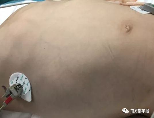 4岁娃肚大如孕妇，竟从体内抽出2斤寄生虫液！