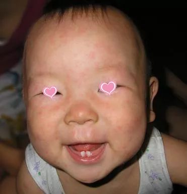 儿童季节性皮疹用什么药最好,儿童常见的出疹疾病