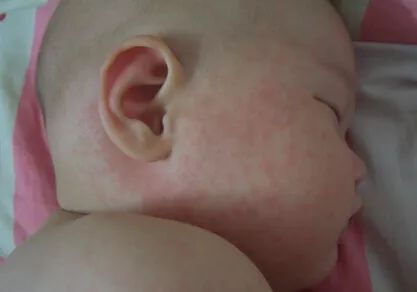 儿童季节性皮疹用什么药最好,儿童常见的出疹疾病