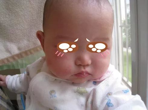 儿童季节性皮疹用什么药最好,儿童常见的出疹疾病