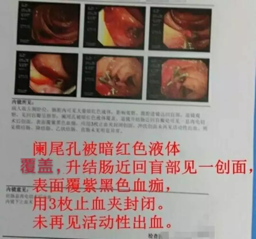 肠息肉内镜切除后迟发性出血，该怎么办？