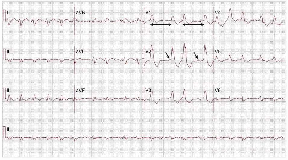 心电图提前出现宽大的qrs波,宽口qrs波心动过速的鉴别诊断