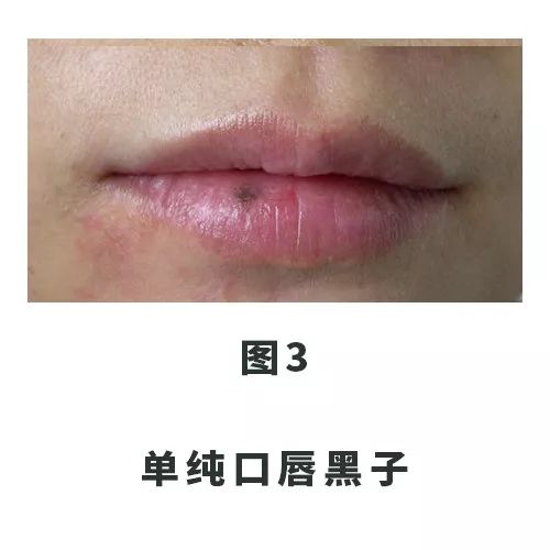 口唇出现黑斑是怎么回事,口唇内壁有黑斑