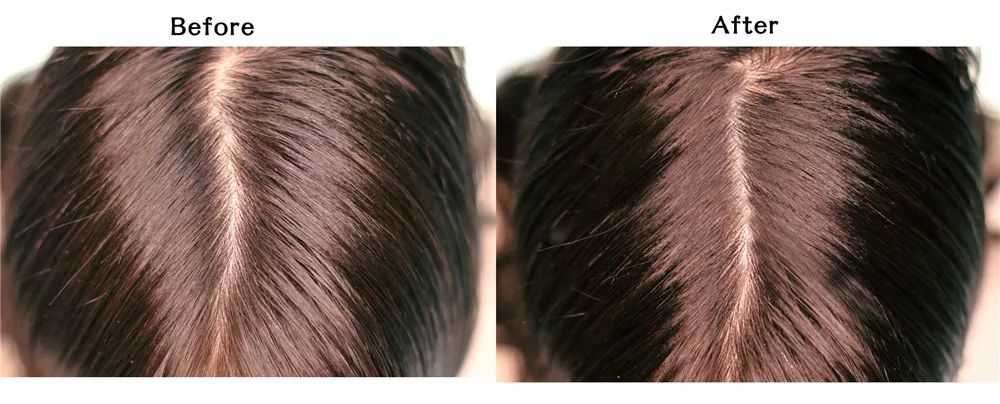 拯救秃头黑科技,秃头女孩最快的拯救办法是什么