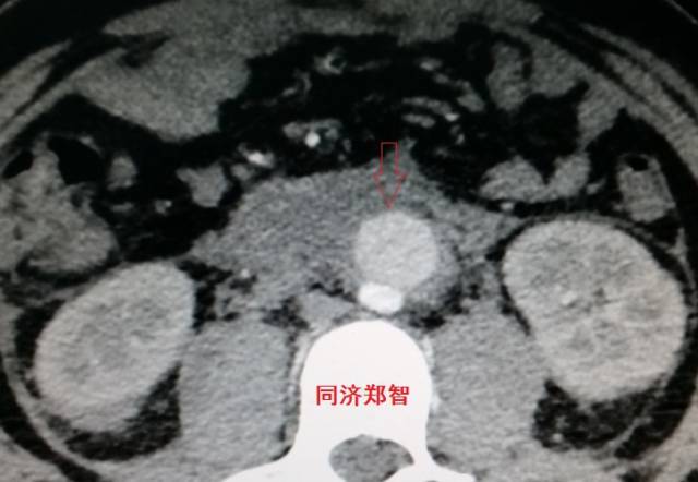 主动脉夹层cta能扫描出来吗,急性主动脉夹层cta影像诊断与鉴别